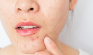 مقالات 1 جوش صورت یا آکنه - الماس زیبایی