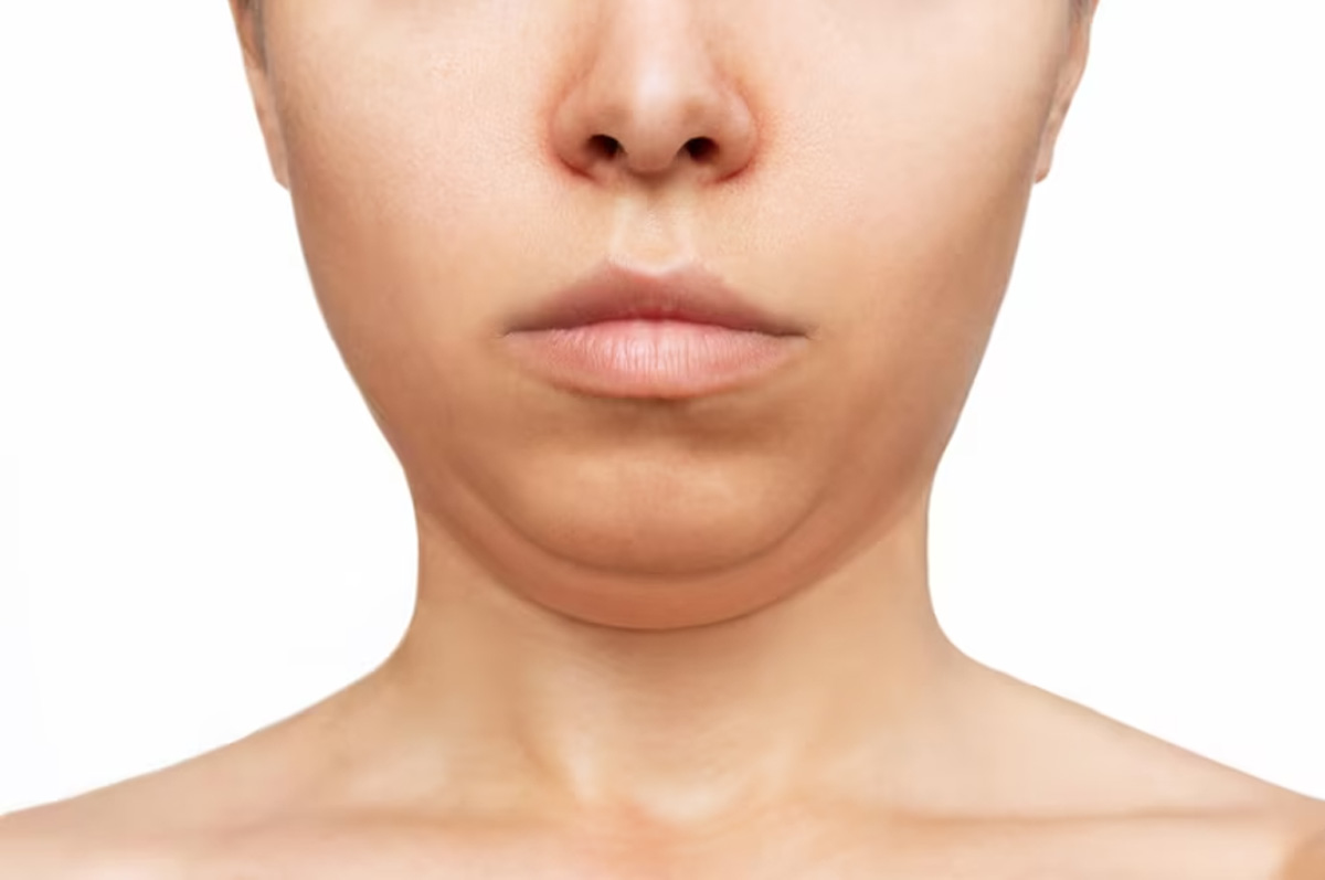 از بین بردن غبغب