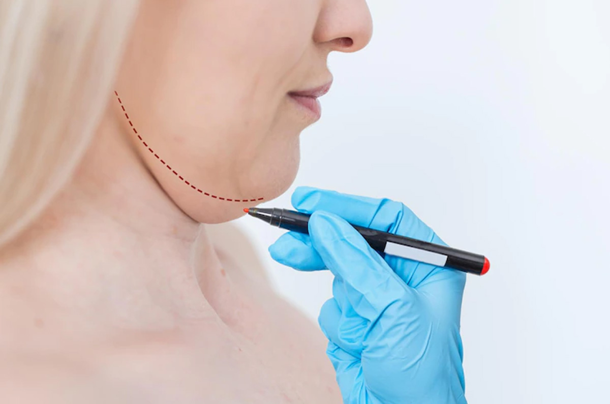 منتوپلاستی و لیفت گردن در تهران